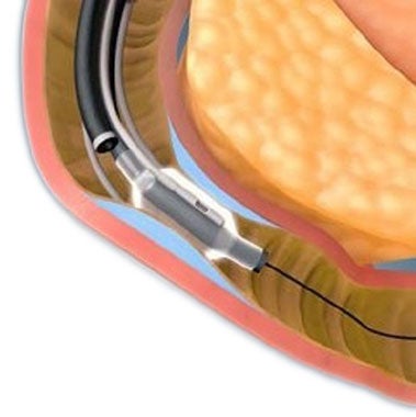 Fractyl's Revita® DMR (duodenal mucosal resurfacing) System