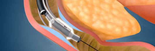 Revita® DMR (duodenal mucosal resurfacing) System close up procedure