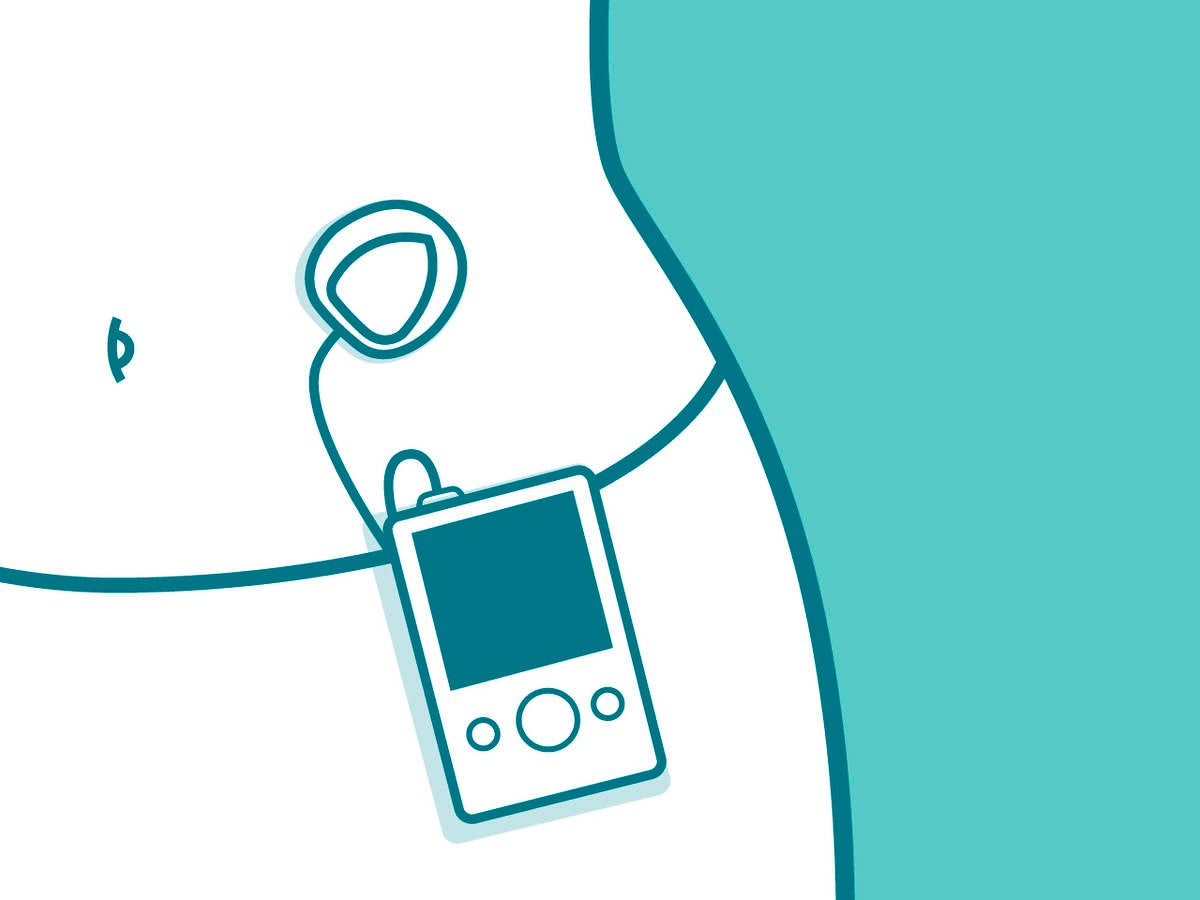 Drawing of a Wearable insulin pump