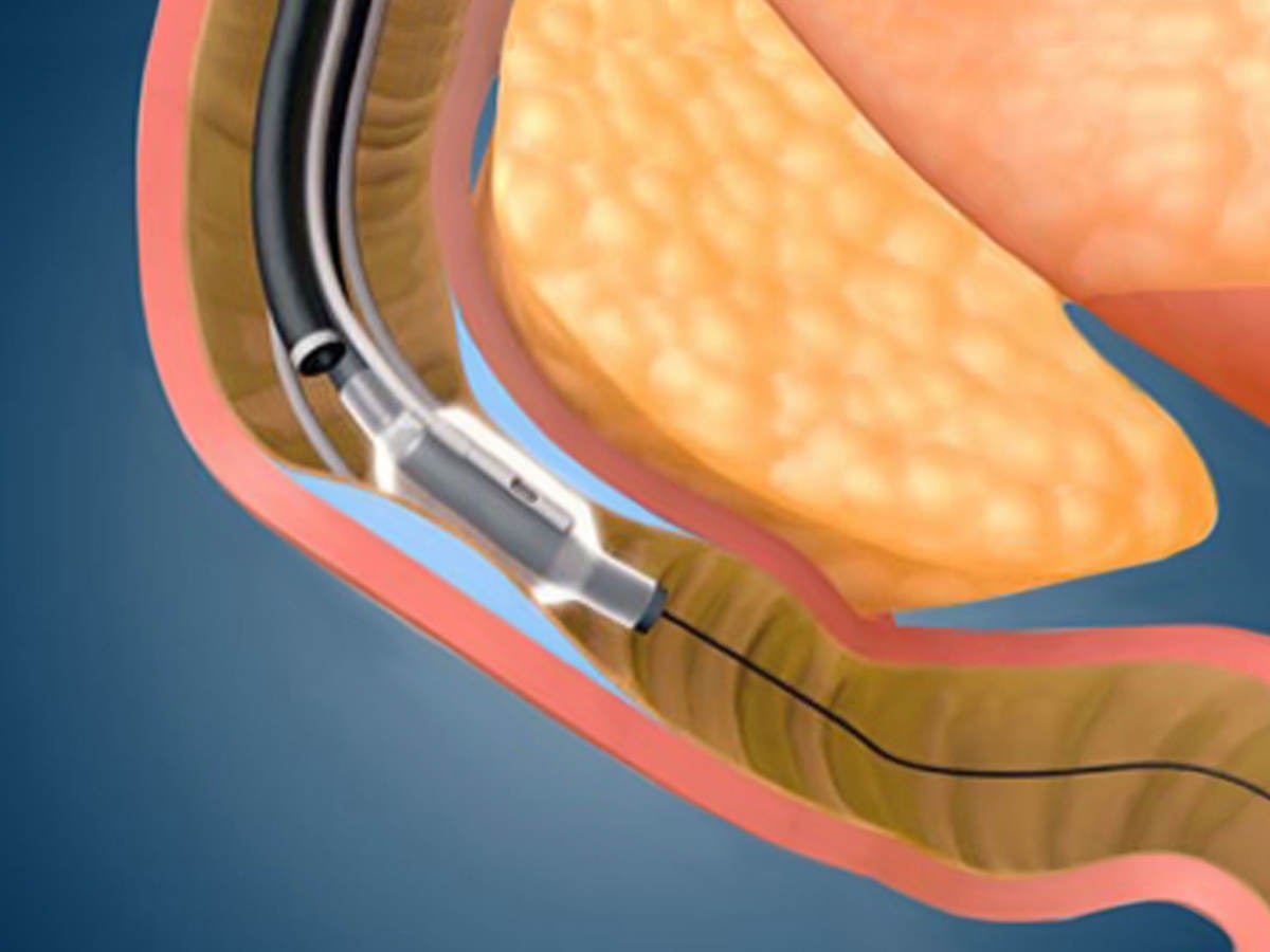 Revita® DMR (duodenal mucosal resurfacing) System close up procedure